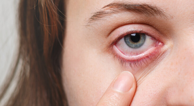 Foto de mulher com olho vermelho. Ela está apoiando a parte inferior do seu olho com seu dedo para mantê-lo aberto. 