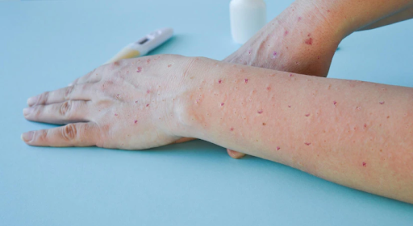 Manchas na pele causadas pela varíola do macaco. 